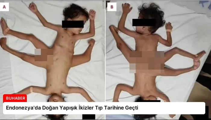 Endonezya’da Doğan Yapışık İkizler Tıp Tarihine Geçti
