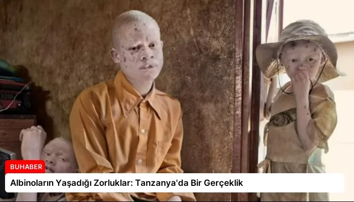 Albinoların Yaşadığı Zorluklar: Tanzanya’da Bir Gerçeklik
