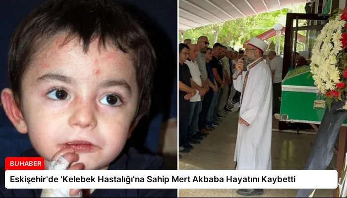Eskişehir’de ‘Kelebek Hastalığı’na Sahip Mert Akbaba Hayatını Kaybetti