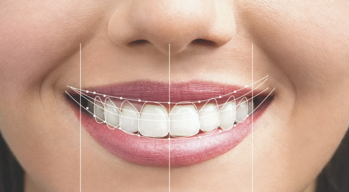 Ankara Gülüş Tasarımı: Mükemmel Gülüşe Giden Yol